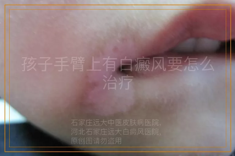 孩子手臂上有白癜风要怎么治疗