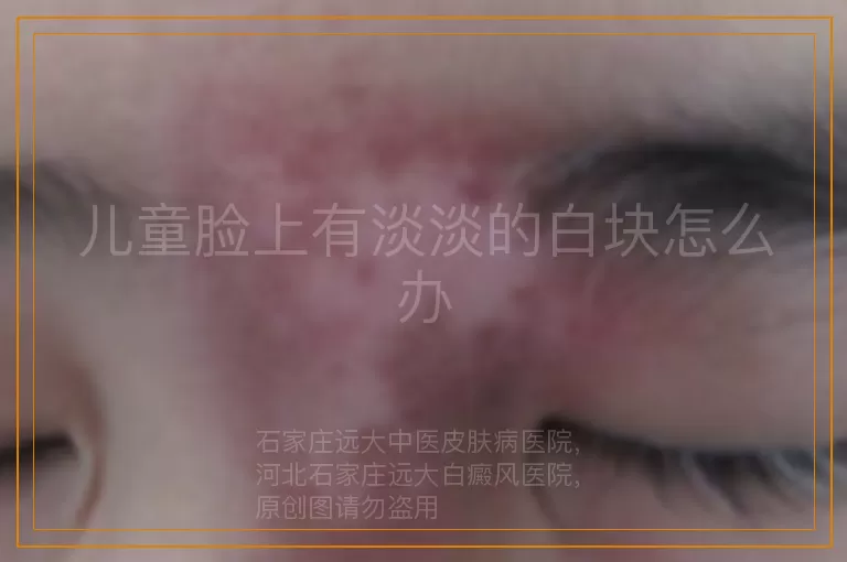 儿童脸上有淡淡的白块怎么办