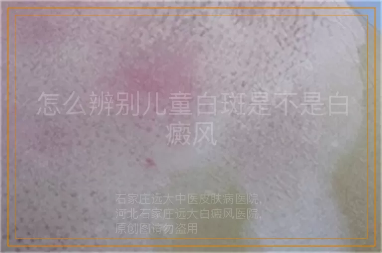 怎么辨别儿童白斑是不是白癜风