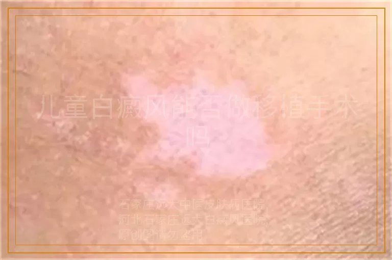 儿童白癜风能否做移植手术吗