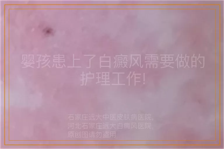 婴孩患上了白癜风需要做的护理工作!