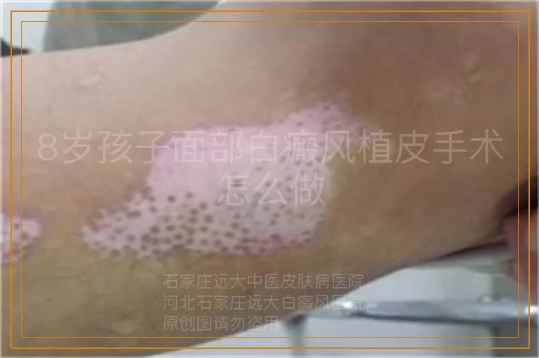 8岁孩子面部白癜风植皮手术怎么做
