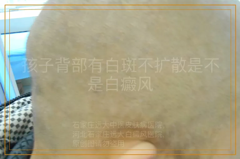 孩子背部有白斑不扩散是不是白癜风