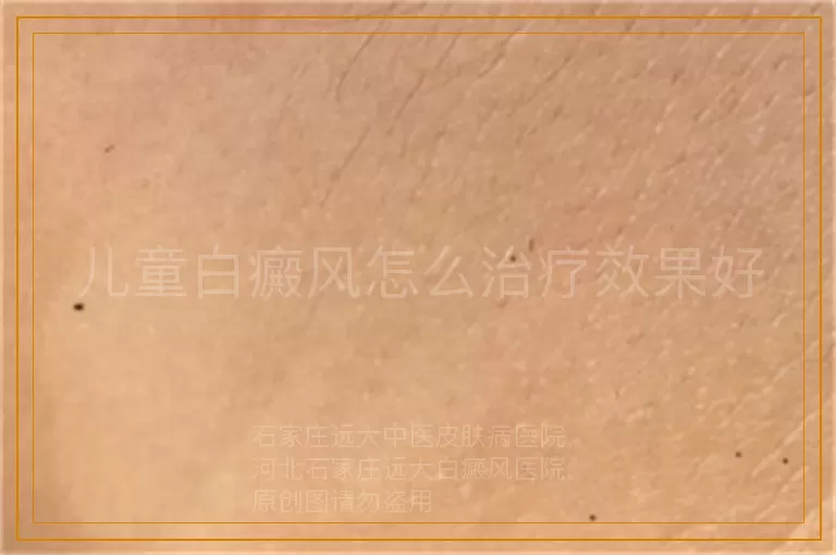 儿童白癜风怎么治疗效果好