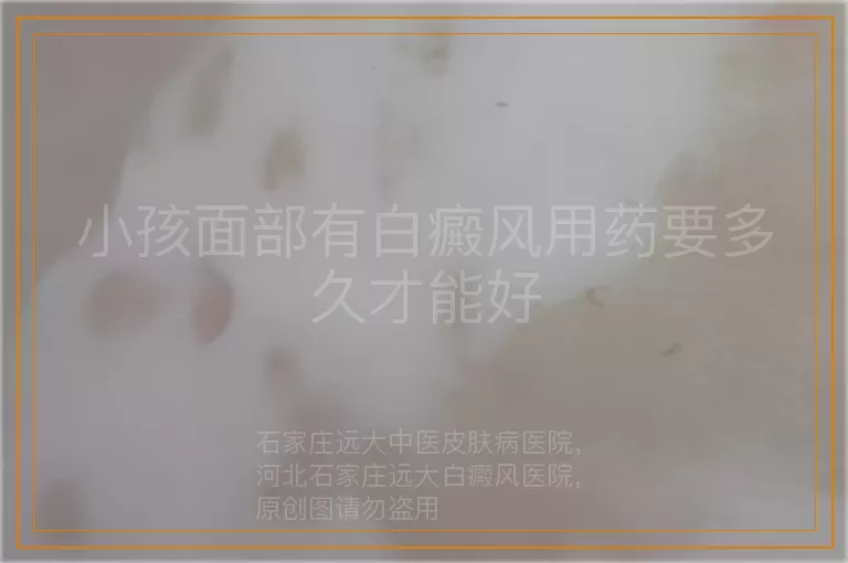 小孩面部有白癜风用药要多久才能好