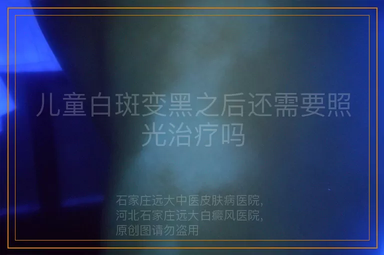 儿童白斑变黑之后还需要照光治疗吗