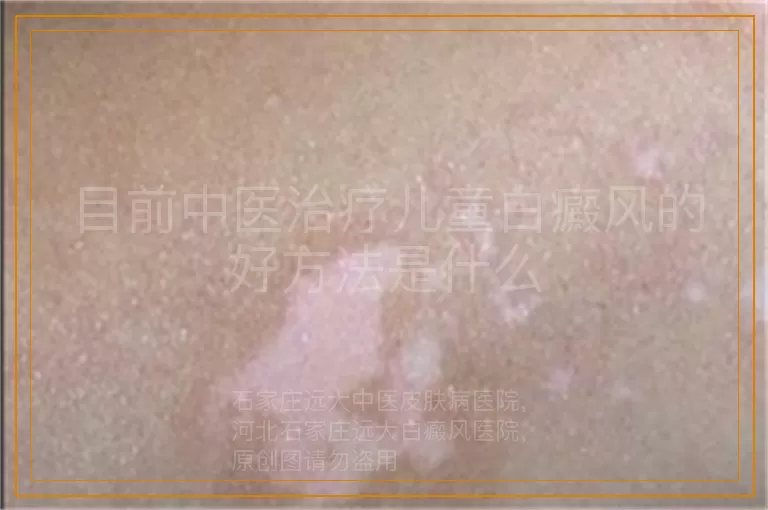 目前中医治疗儿童白癜风的好方法是什么