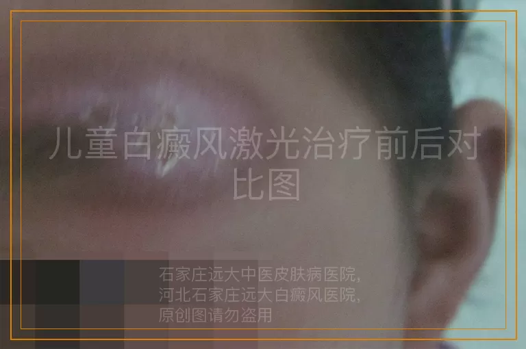 儿童白癜风激光治疗前后对比图