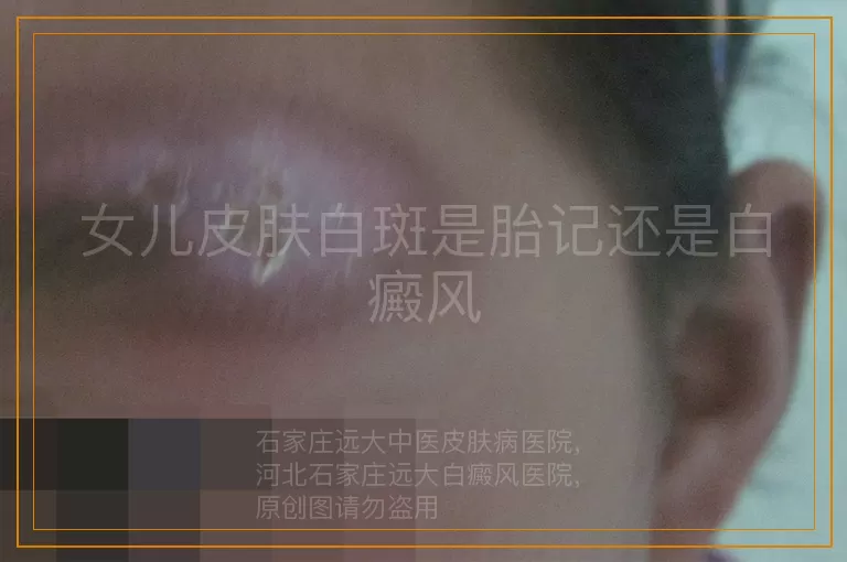 女儿皮肤白斑是胎记还是白癜风