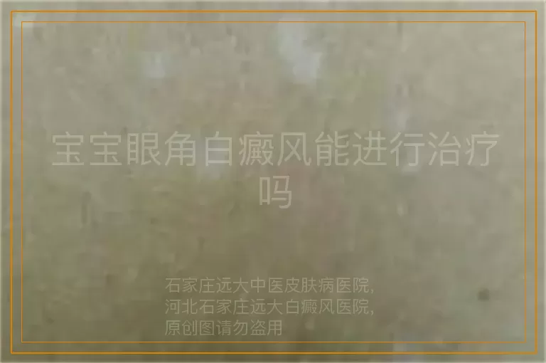 宝宝眼角白癜风能进行治疗吗