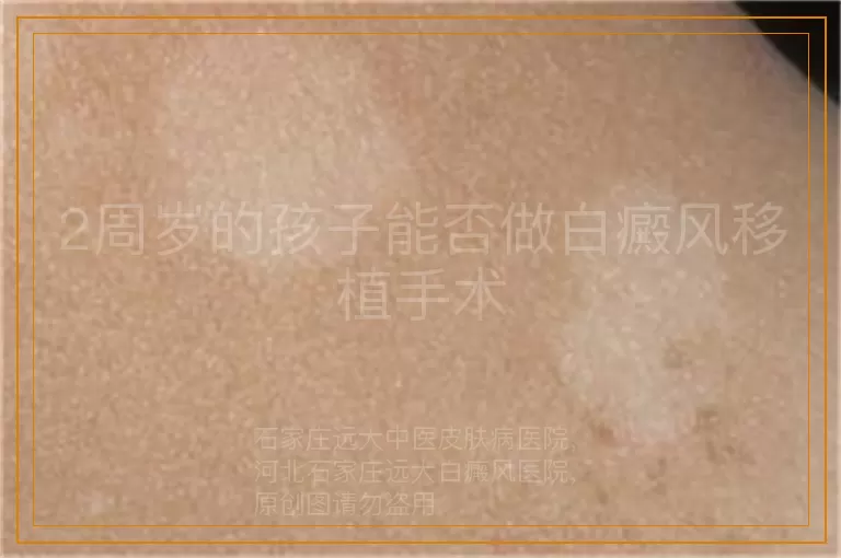 2周岁的孩子能否做白癜风移植手术