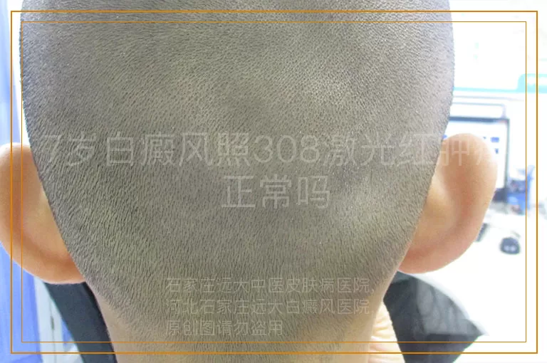 7岁白癜风照308激光红肿疼正常吗