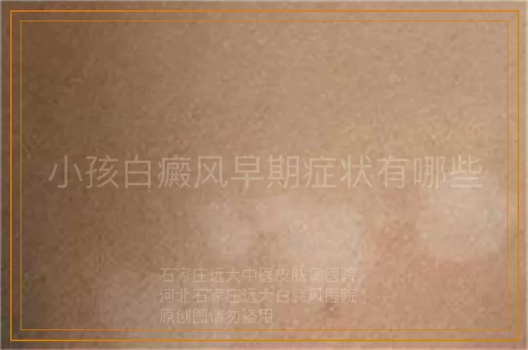 小孩白癜风早期症状有哪些
