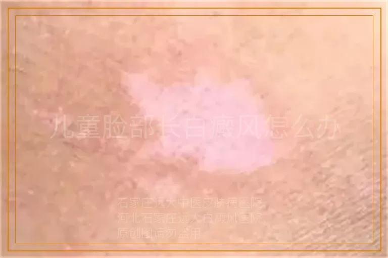 儿童脸部长白癜风怎么办