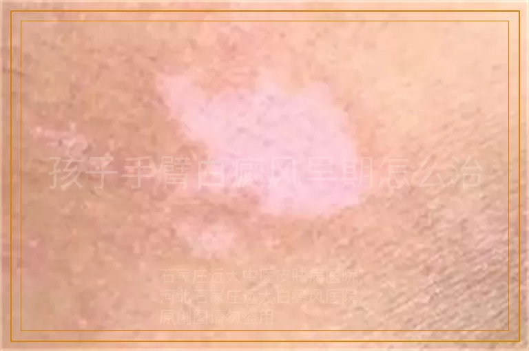 孩子手臂白癜风早期怎么治