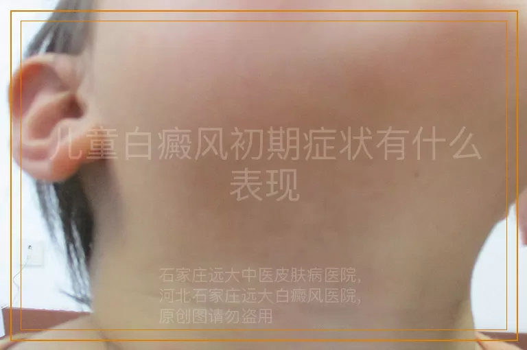 儿童白癜风初期症状有什么表现