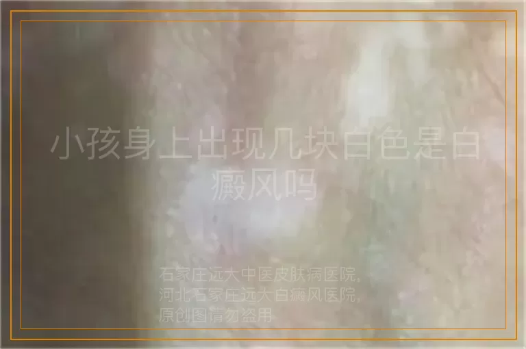 小孩身上出现几块白色是白癜风吗