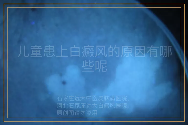 儿童患上白癜风的原因有哪些呢
