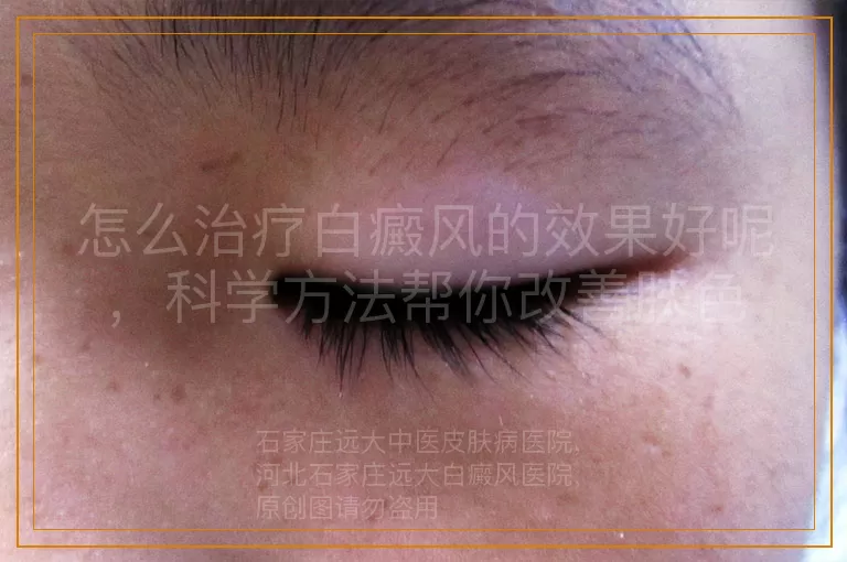 怎么治疗白癜风的效果好呢，科学方法帮你改善肤色