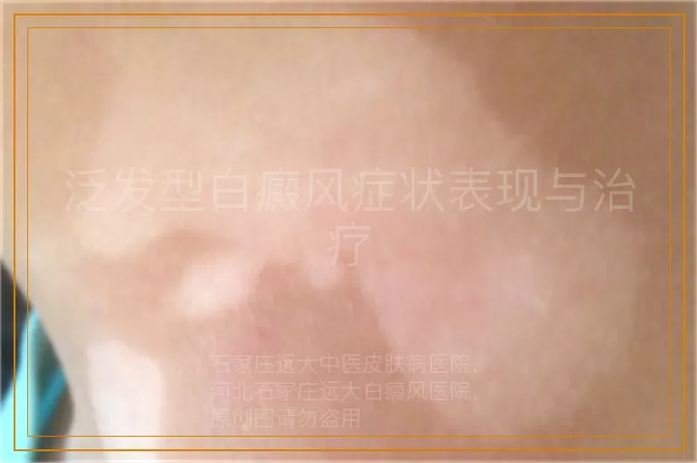 泛发型白癜风症状表现与治疗
