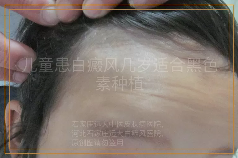 儿童患白癜风几岁适合黑色素种植