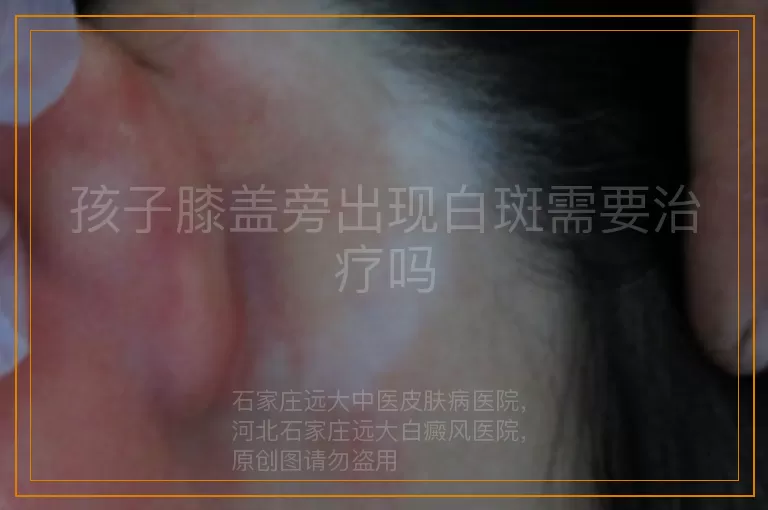 孩子膝盖旁出现白斑需要治疗吗