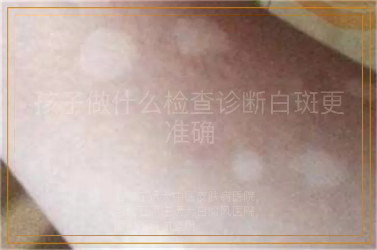 孩子做什么检查诊断白斑更准确
