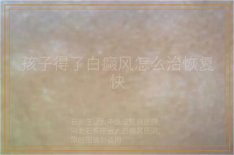 孩子得了白癜风怎么治恢复快