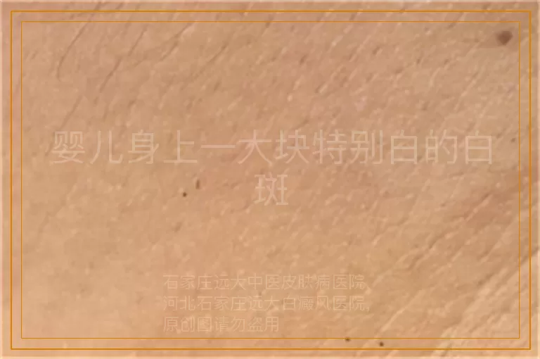 婴儿身上一大块特别白的白斑