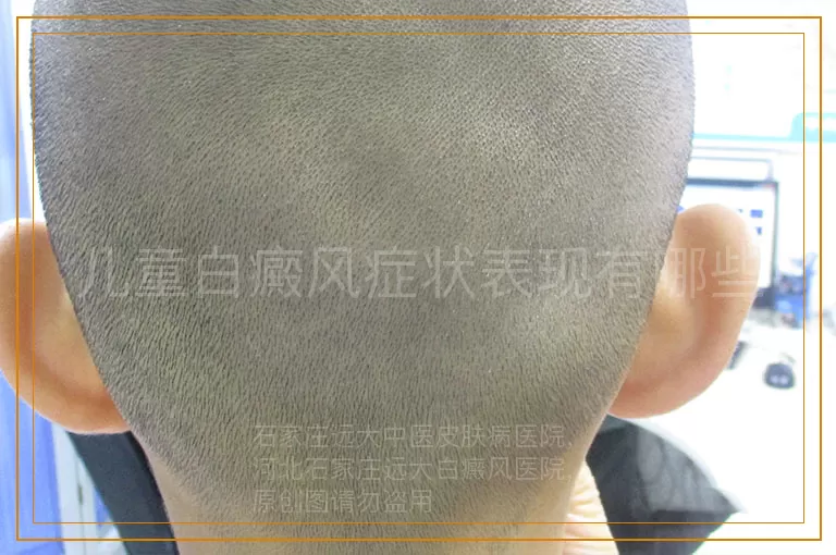 儿童白癜风症状表现有哪些