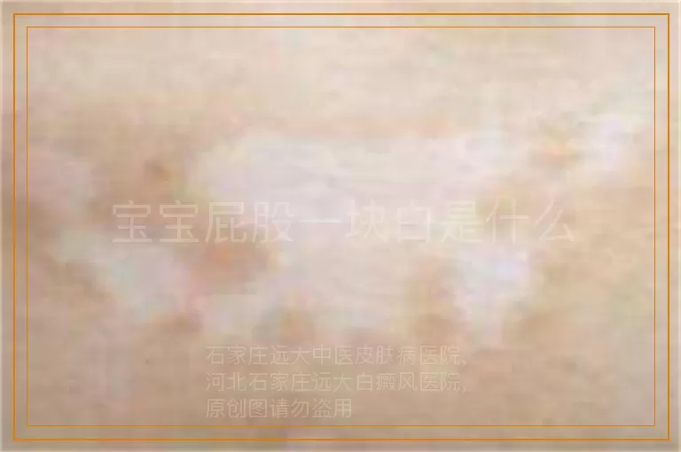 宝宝屁股一块白是什么