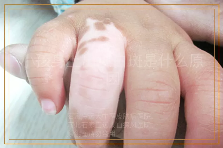 小孩身上出现白斑是什么原因
