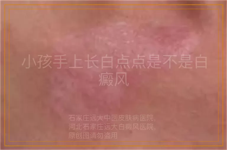 小孩手上长白点点是不是白癜风