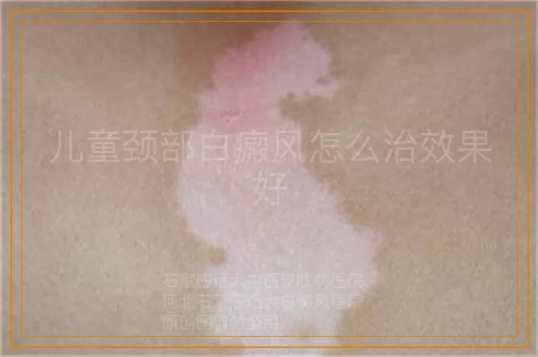 儿童颈部白癜风怎么治效果好