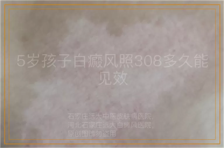5岁孩子白癜风照308多久能见效