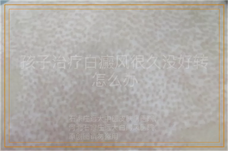 孩子治疗白癜风很久没好转怎么办