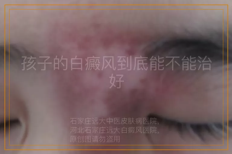 孩子的白癜风到底能不能治好