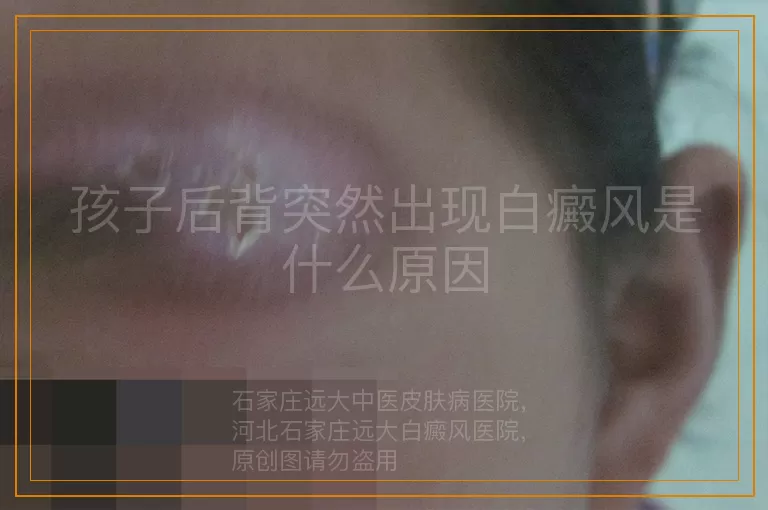 孩子后背突然出现白癜风是什么原因
