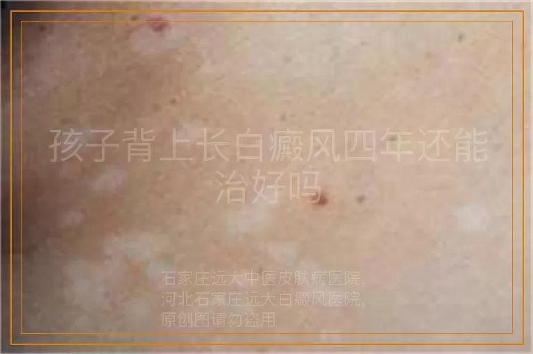 孩子背上长白癜风四年还能治好吗