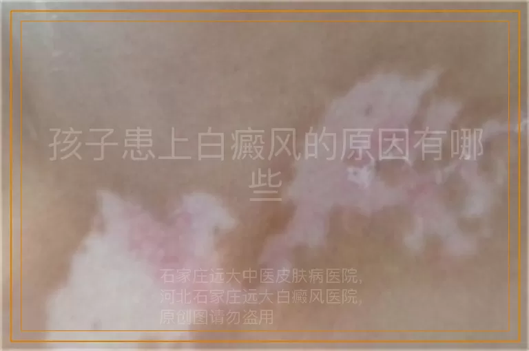 孩子患上白癜风的原因有哪些