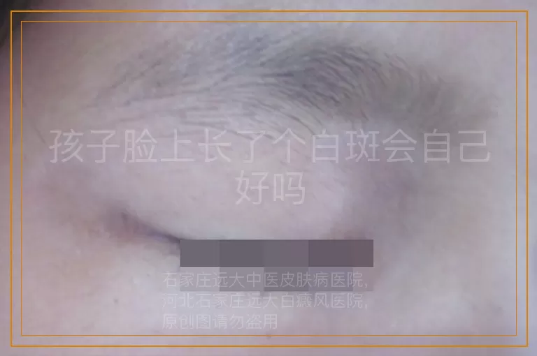 孩子脸上长了个白斑会自己好吗