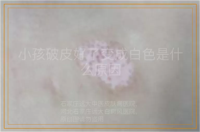 小孩破皮好了变成白色是什么原因