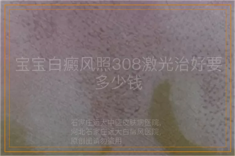 宝宝白癜风照308激光治好要多少钱