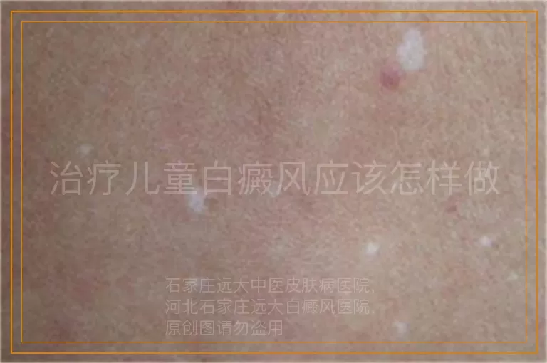 治疗儿童白癜风应该怎样做
