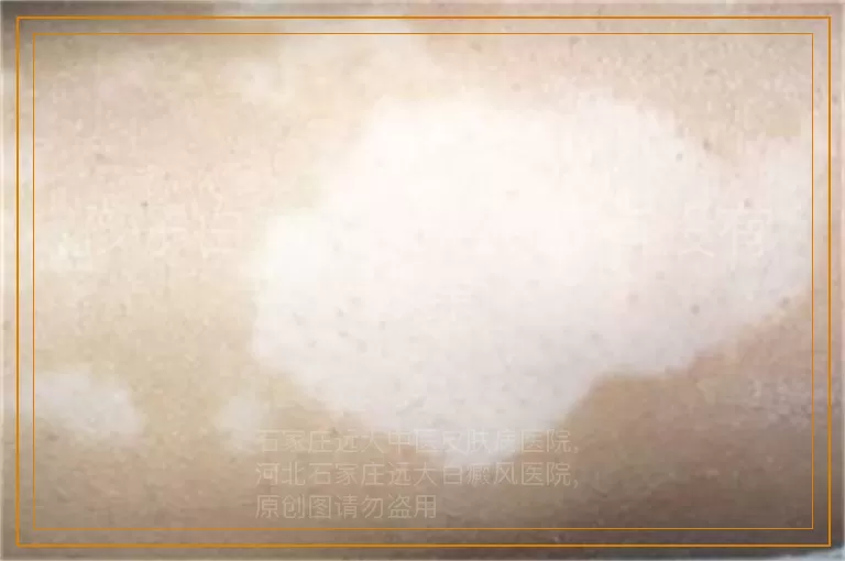孩子白癜风照光治疗有没有效果