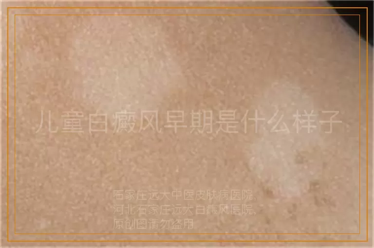 儿童白癜风早期是什么样子