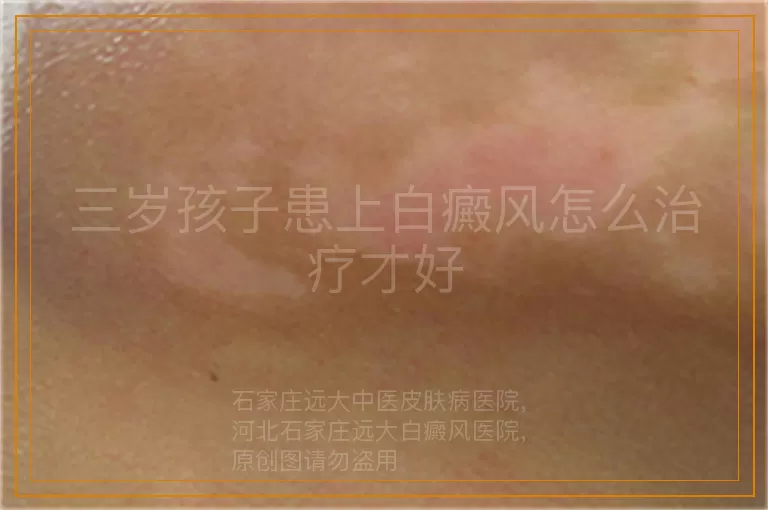 三岁孩子患上白癜风怎么治疗才好