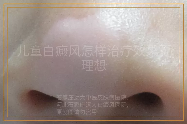 儿童白癜风怎样治疗效果更理想