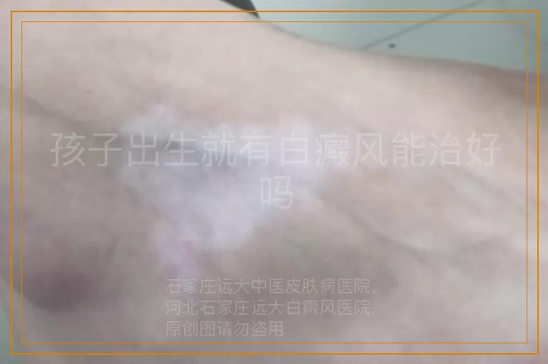 孩子出生就有白癜风能治好吗