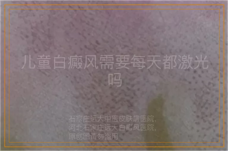 儿童白癜风需要每天都激光吗